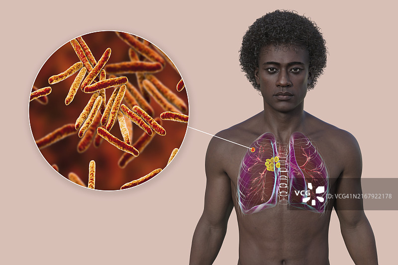原发性肺结核插图图片素材