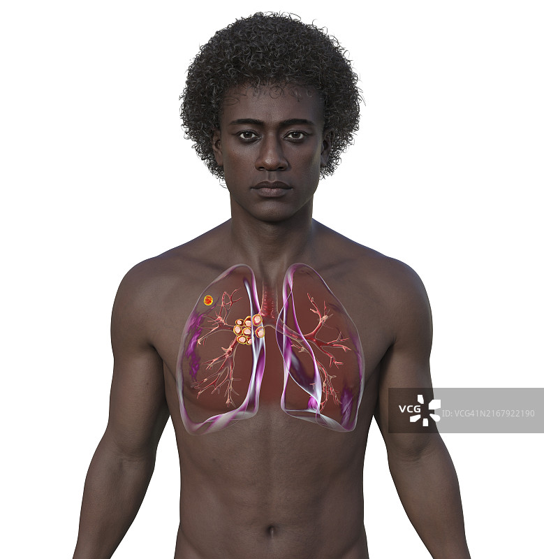 原发性肺结核插图图片素材