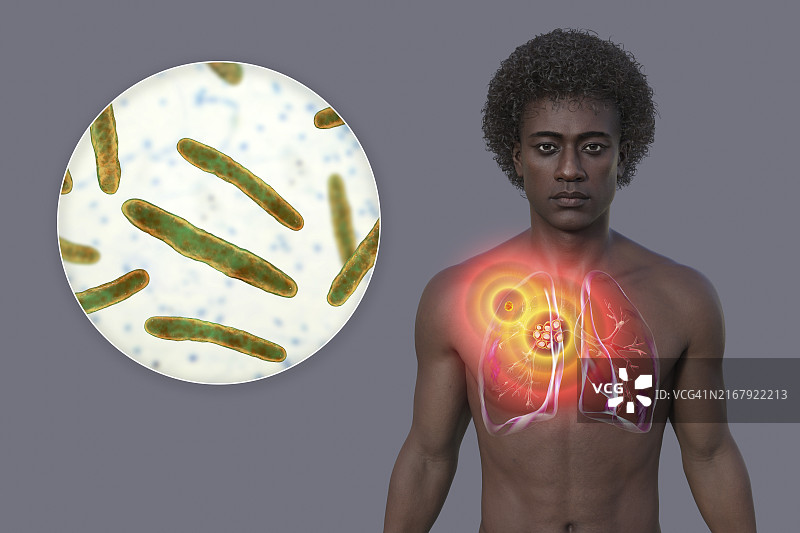 原发性肺结核插图图片素材