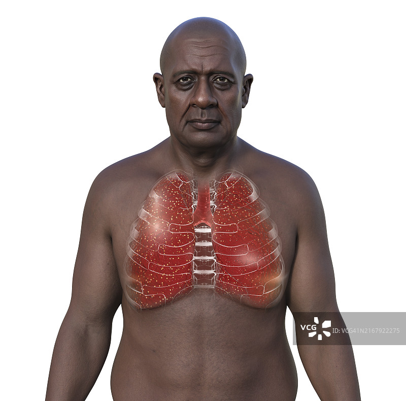 囊性纤维化引起的肺部病变图片素材