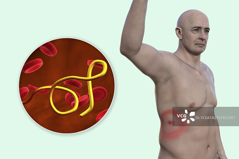 莱姆病插图图片素材