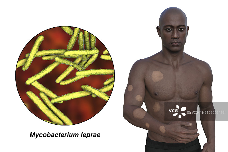 结核样麻风病插图图片素材