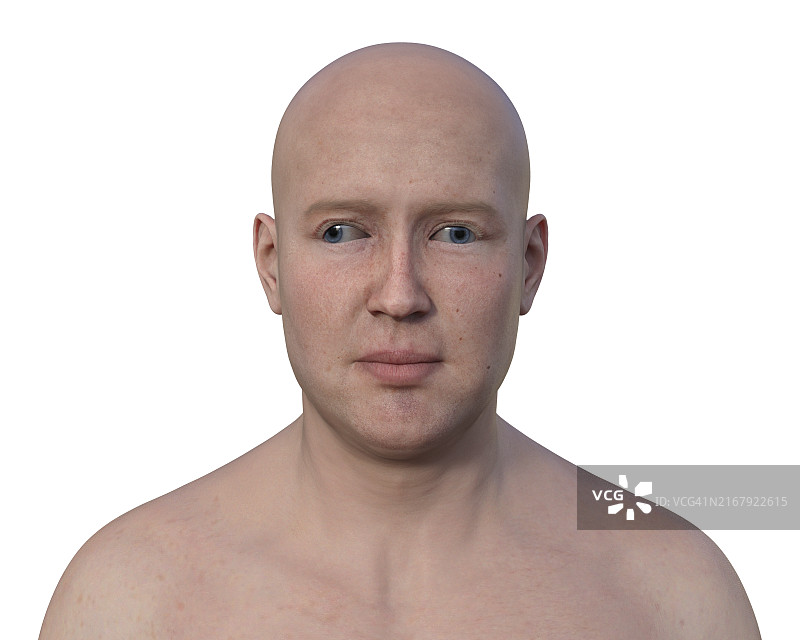 患有外斜视的男人插图图片素材