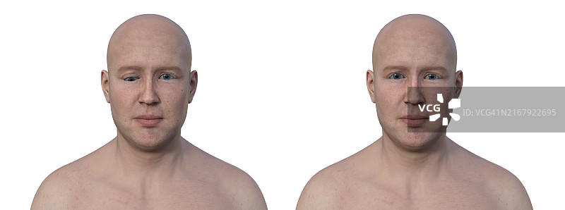 内斜视男人，插图图片素材