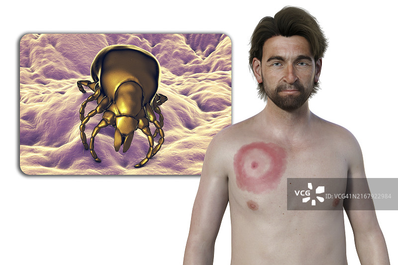 患有莱姆病游走性红斑的男人，图示图片素材