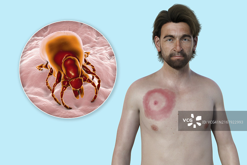 患有莱姆病游走性红斑的男人，图示图片素材