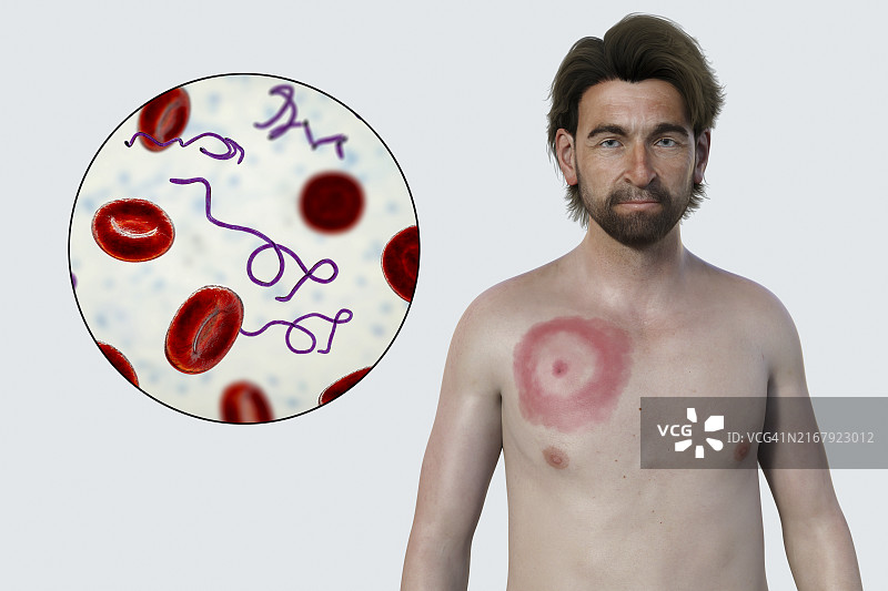 患有莱姆病游走性红斑的男人，图示图片素材