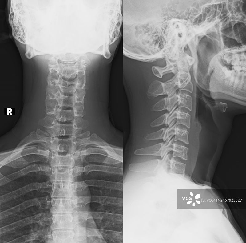 正常颈椎X光片图片素材