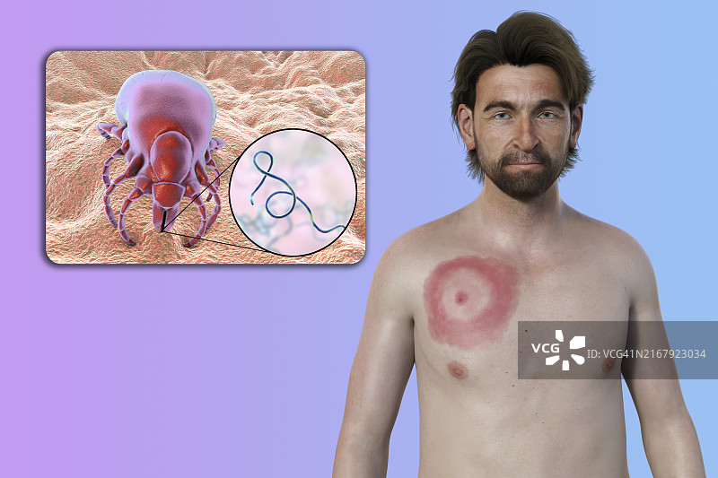 患有莱姆病游走性红斑的男人，图示图片素材
