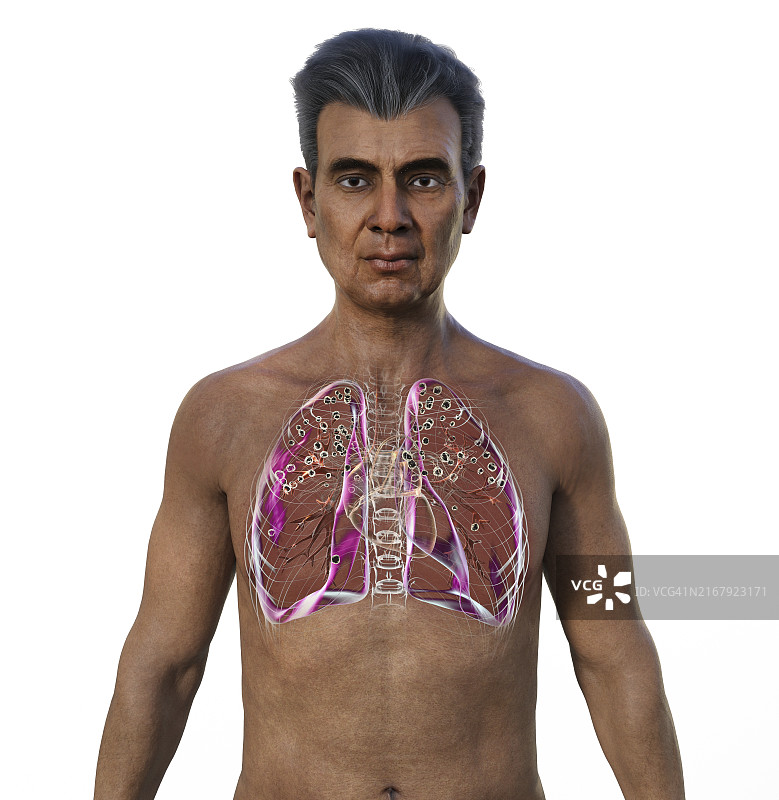 肺部受矽肺病影响的男人，插图图片素材