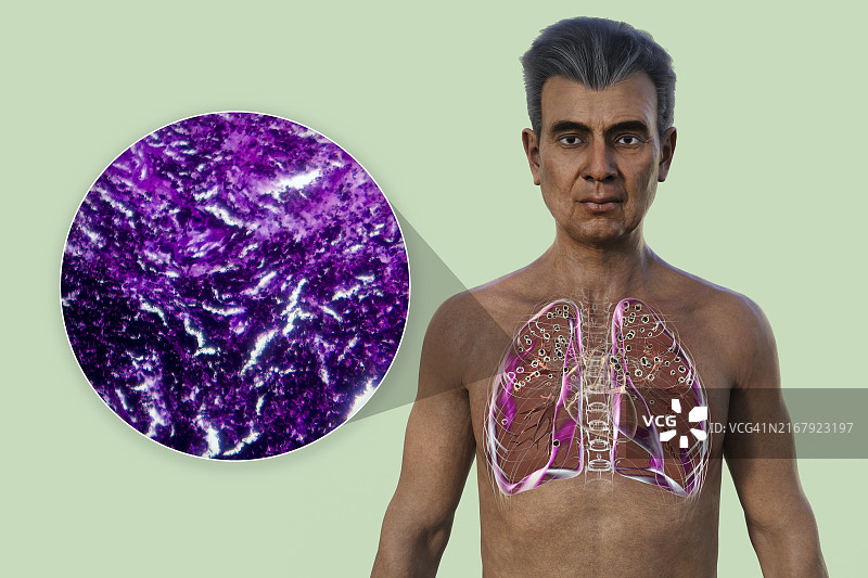 肺部受矽肺病影响的男人，插图图片素材