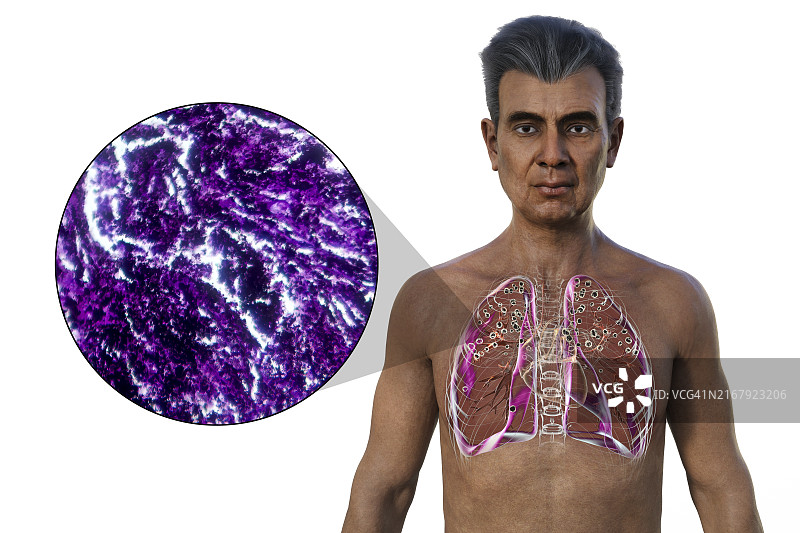 肺部受矽肺病影响的男人，插图图片素材