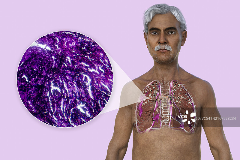 肺部受矽肺病影响的男人，插图图片素材