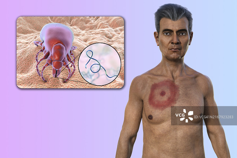 患有莱姆病游走性红斑的男人，图示图片素材