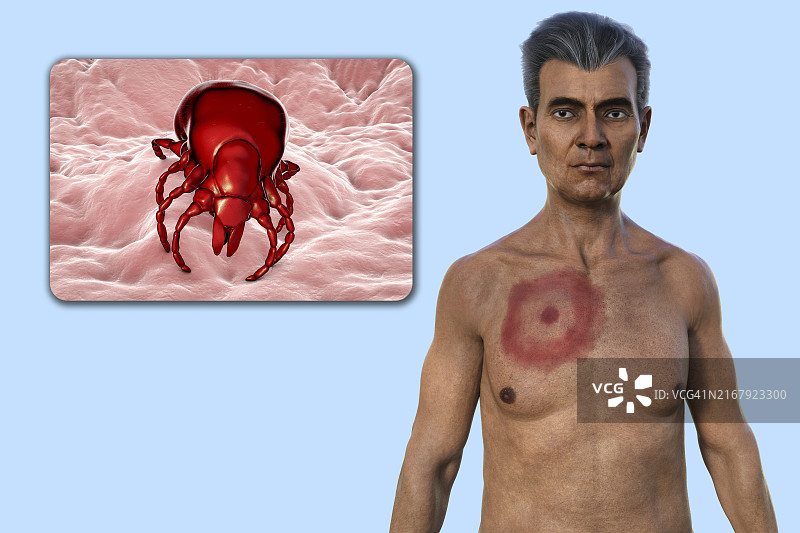 患有莱姆病游走性红斑的男人，图示图片素材