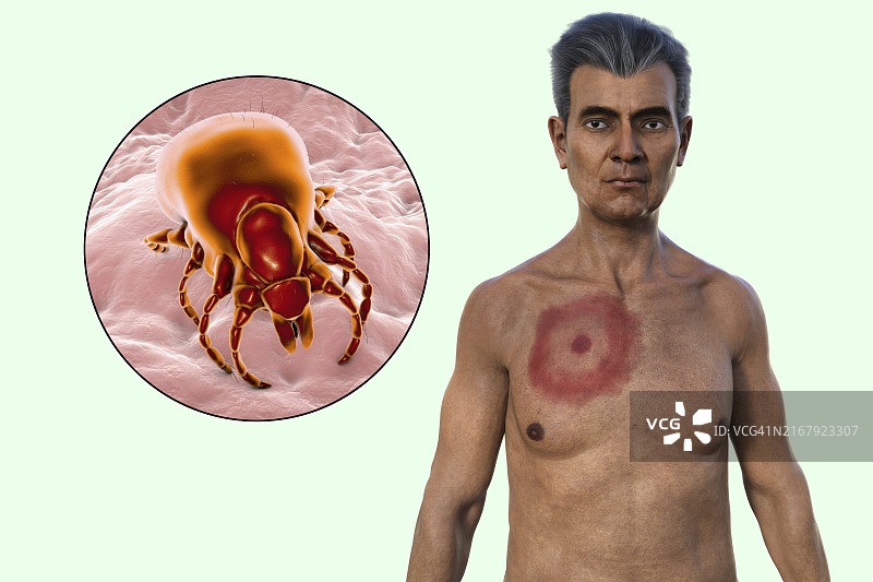 患有莱姆病游走性红斑的男人，图示图片素材