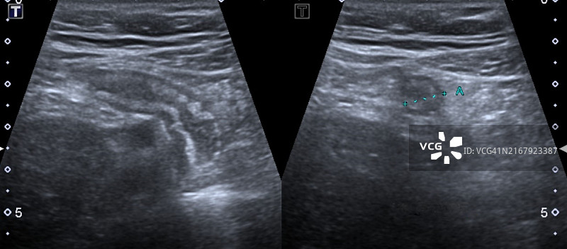 阑尾炎超声扫描图片素材