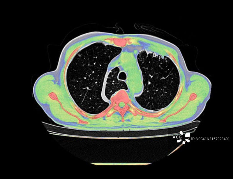 奇静脉叶CT扫描图片素材