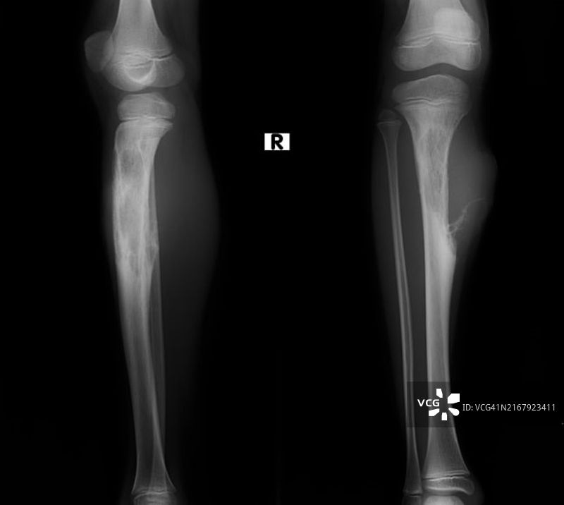 胫骨骨癌X光片图片素材