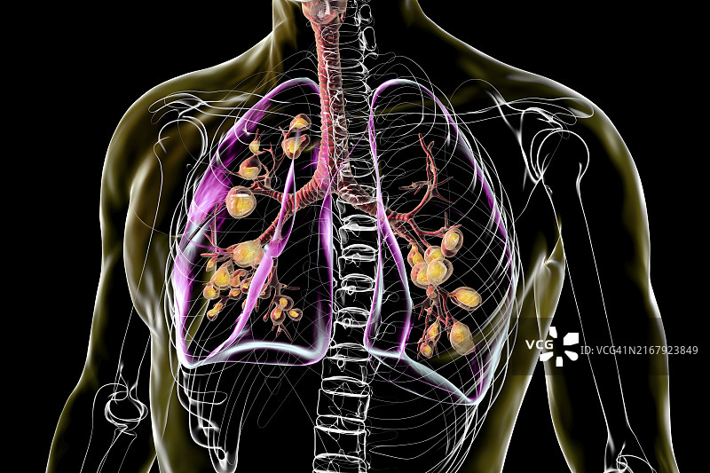 囊性纤维化影响的肺部，图示图片素材