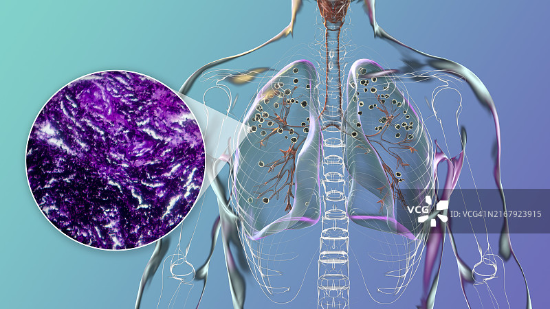 受矽肺影响的肺部插图图片素材