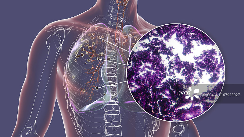受矽肺影响的肺部插图图片素材