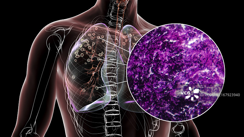 受矽肺影响的肺部插图图片素材