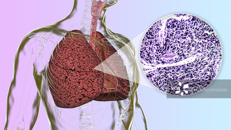 吸烟者的肺部插图图片素材