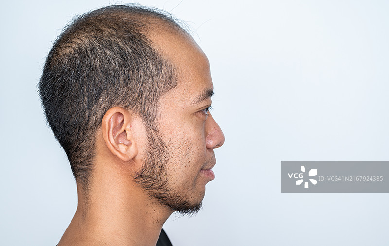 亚洲男人头皮，头发稀少。脱发与基因和男性性激素有关。图片素材