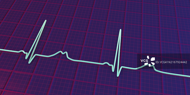 长QT综合征2型心电图图示图片素材