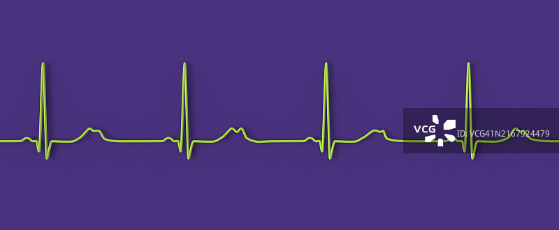 长QT综合征2型心电图图示图片素材