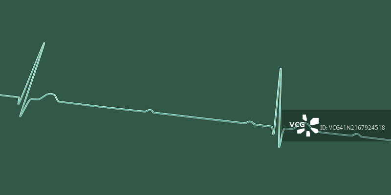 心脏传导阻滞心电图图片素材