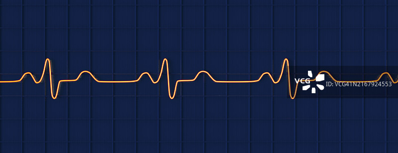 束支传导阻滞心电图插图图片素材