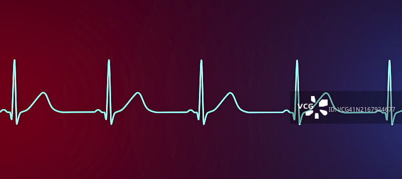 长QT综合征心电图，图示图片素材