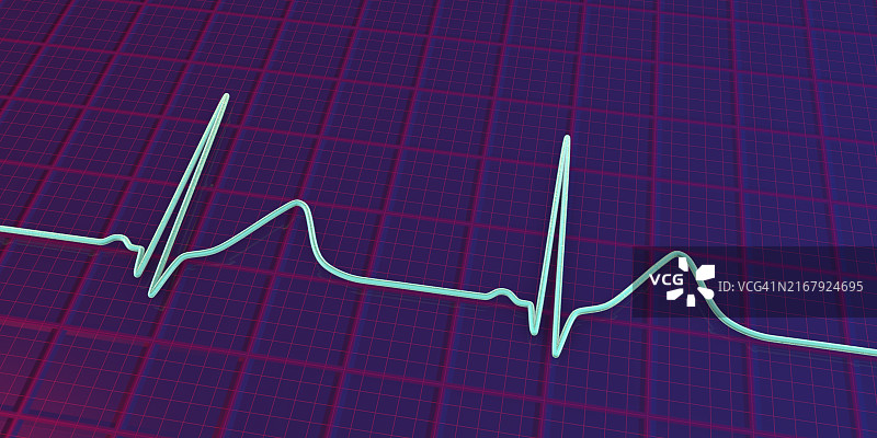 长QT综合征心电图，图示图片素材