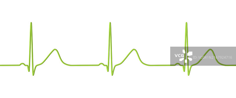 长QT综合征心电图，图示图片素材