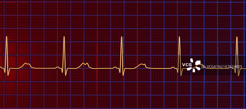 长QT综合征2型心电图图示图片素材