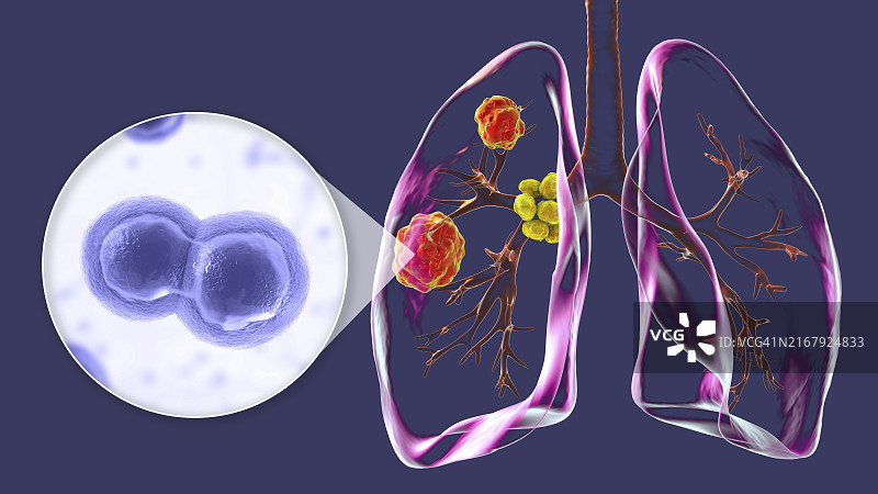 肺芽生菌病插图图片素材