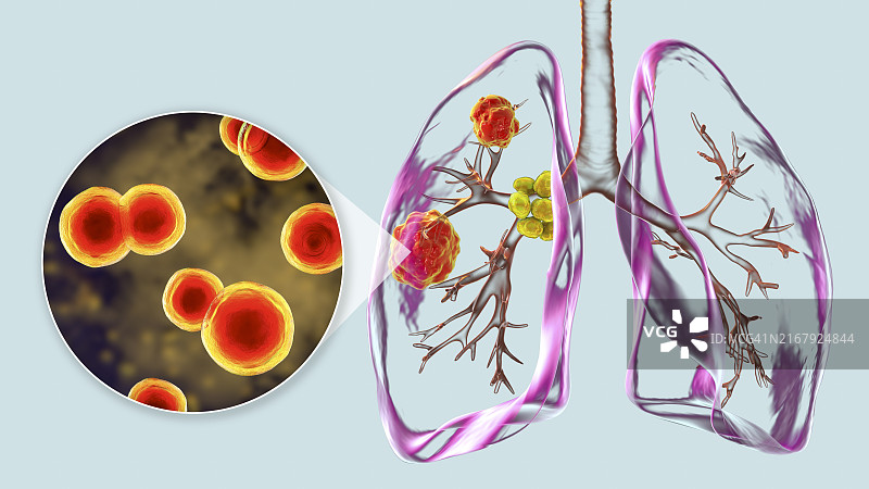 肺芽生菌病插图图片素材