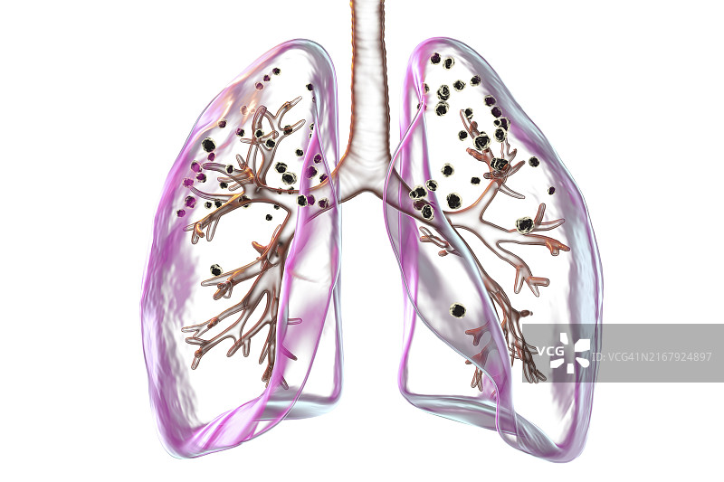 受矽肺影响的肺部插图图片素材