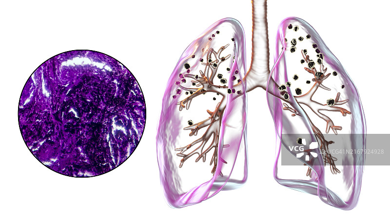 矽肺病肺部影响示意图及显微照片图片素材