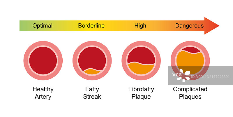 动脉粥样硬化阶段图示图片素材