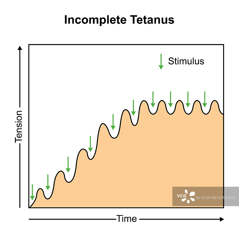 不完全性破伤风肌肉收缩插图图片素材