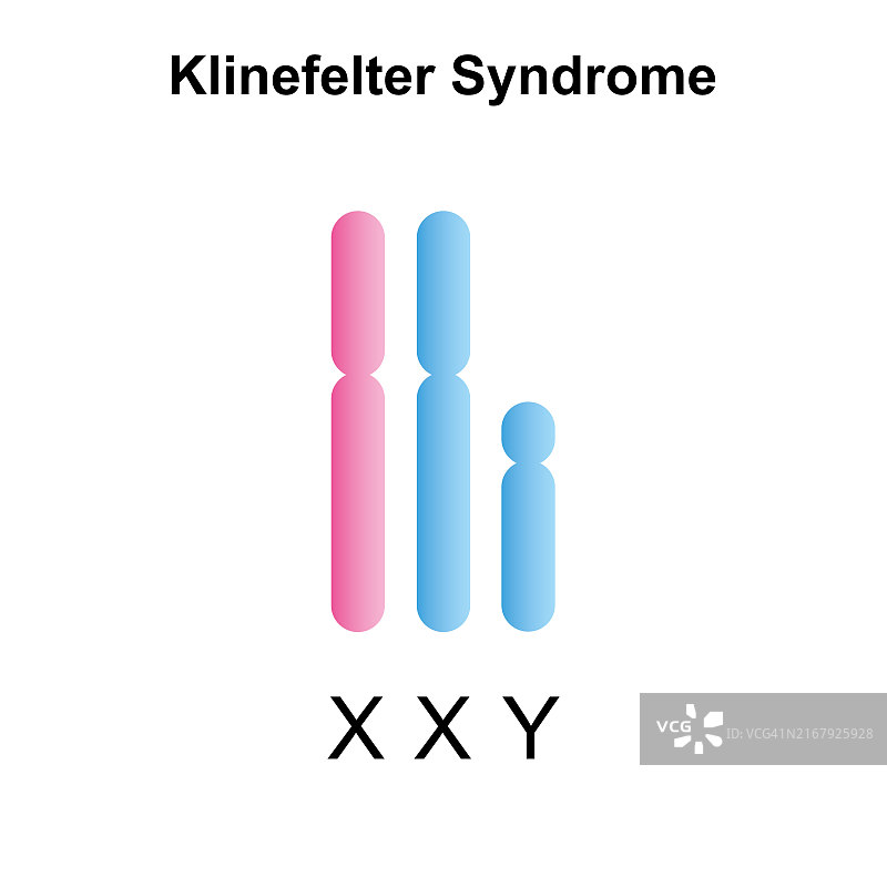 克氏综合征插图图片素材