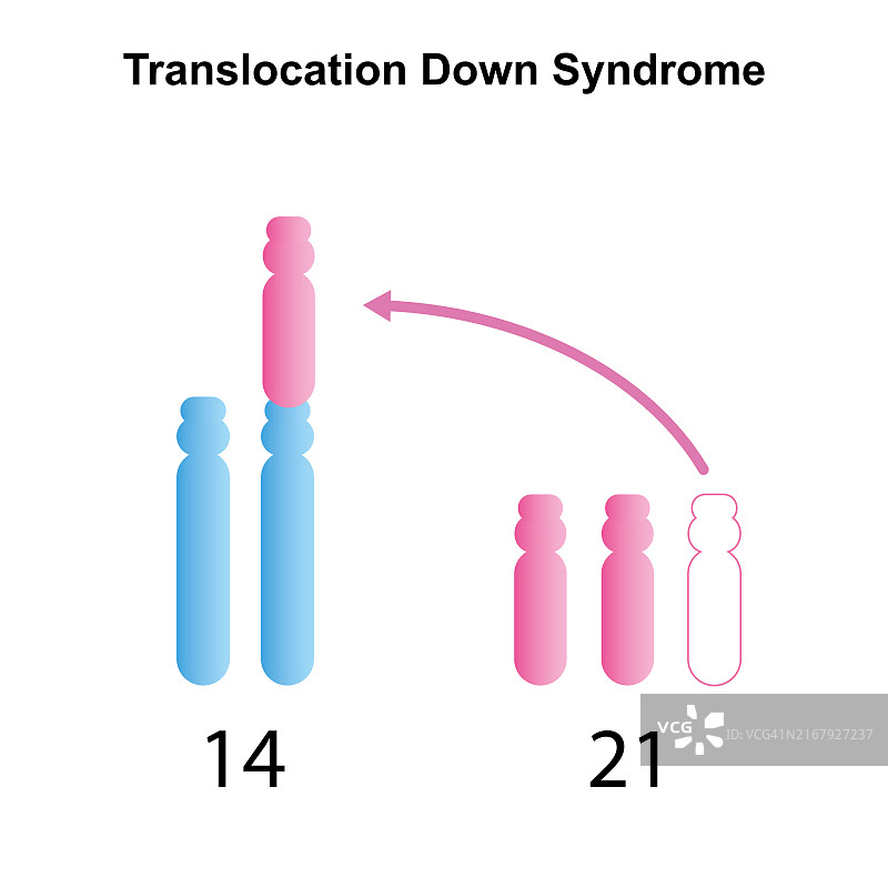 易位唐氏综合征，图示图片素材
