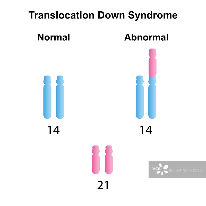 易位唐氏综合征，图示图片素材