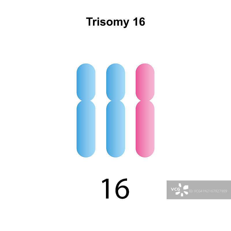 16号染色体三体综合征，图示图片素材