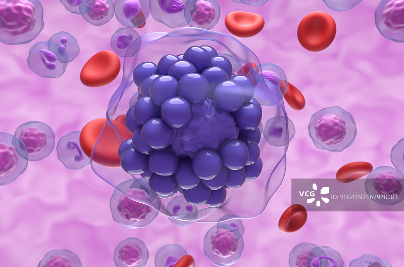 弥漫大B细胞淋巴瘤插图图片素材