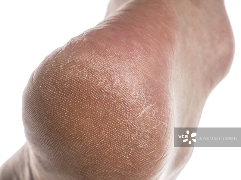 脚后跟皮肤干燥的人的特写图片素材