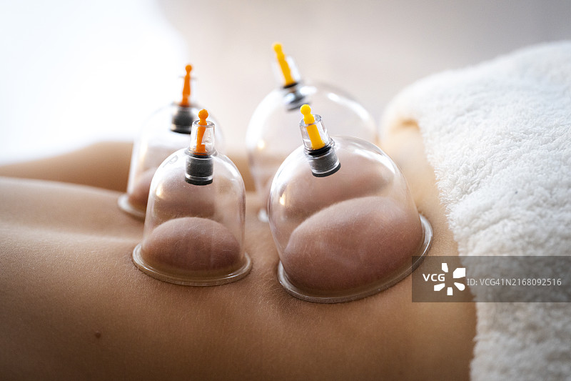 少女在诊所接受拔罐疗法图片素材